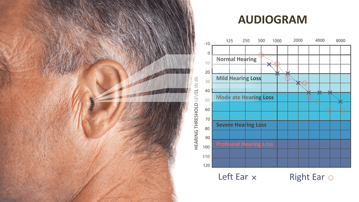 The audiogram - how to read it